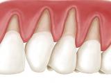 Retração gengival e hipersensibilidade dentária